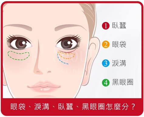 笑起來眼袋很大|臥蠶、淚溝、眼袋、黑眼圈怎麼分？一篇讓你看懂如何有效消除眼。